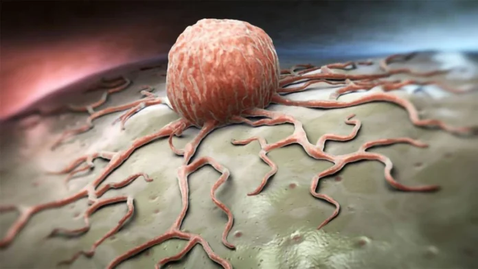 ultrasound-tumor